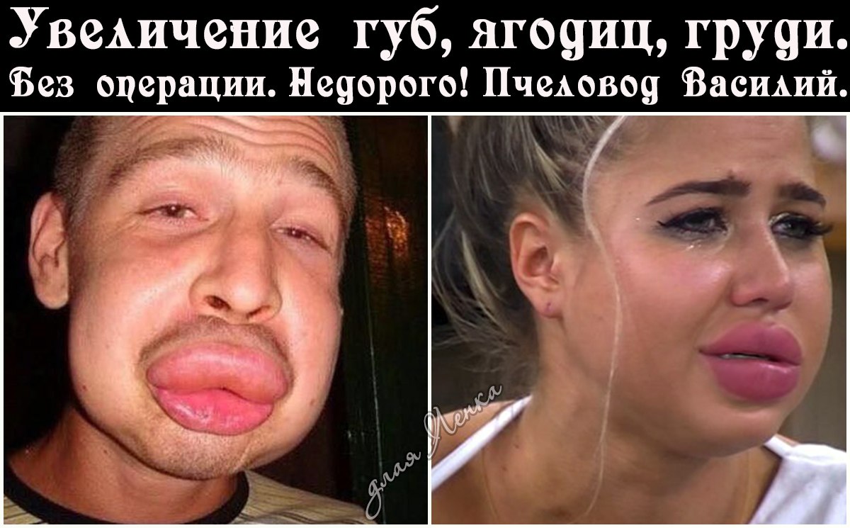 Чем увеличивают губы на доме 2 Чем увеличивают губы на доме 2